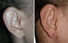 protruding-ears-1-050 13