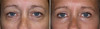 eyelid-surgery-1-023 3