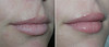 lip-implant-1-038 0