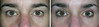 eyelid-surgery-2-086 14