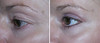 eyelid-surgery-1-064 5