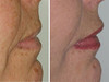 lip-implant-1-027 7