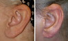 earlobe-reduction-1-007 6