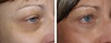 eyelid-surgery-5-030 10
