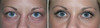 eyelid-surgery-2-004 0