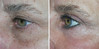 eyelid-surgery-2-109 1
