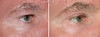 eyelid-surgery-2-068 7