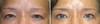 eyelid-surgery-7-023 5