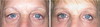 eyelid-surgery-7-020 6