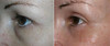 eyelid-surgery-3-002 10