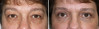 eyelid-surgery-3-011 9