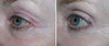 eyelid-surgery-2-009 9
