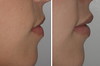 lip-implant-1-060 4