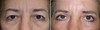 eyelid-surgery-5-047 8