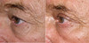 eyelid-surgery-1-009 8