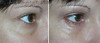 eyelid-surgery-2-076 15