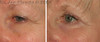eyelid-surgery-2-070 9