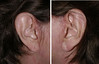 facelift-incisions-1-013 11