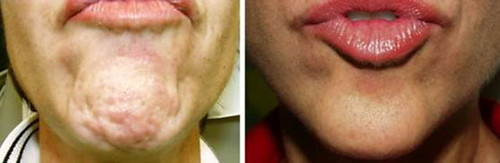 botox-chin-1-001 | by lovethatface