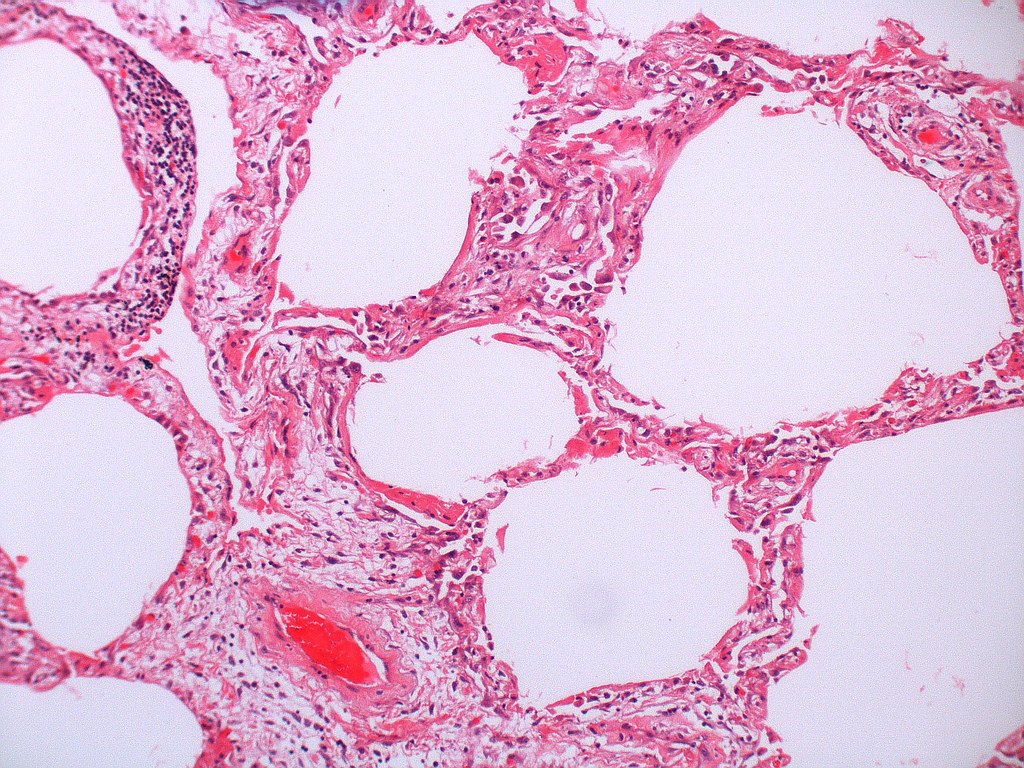 Diffuse alveolar damage-organizing/proliferative phase  Case 133