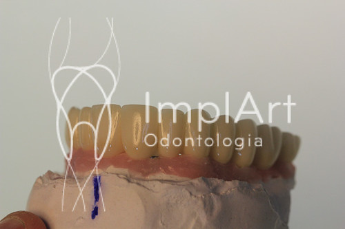 implante dentario total (343).jpg | by Implart