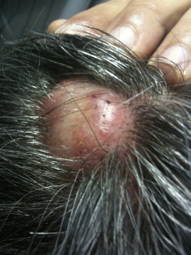 A boil on my bosses head | Ouch | b_3dub78 | Flickr