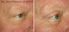 eyelid-surgery-2-056 14