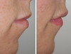 lip-implant-1-001 0