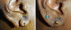 earlobe-repair-1-012 11