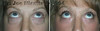 eyelid-surgery-2-045 3