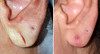 earlobe-repair-1-029 10