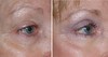 eyelid-surgery-8-003 4