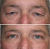 eyelid-surgery-5-007 4