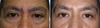 eyelid-surgery-6-010 0