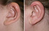 protruding-ears-2-027 0