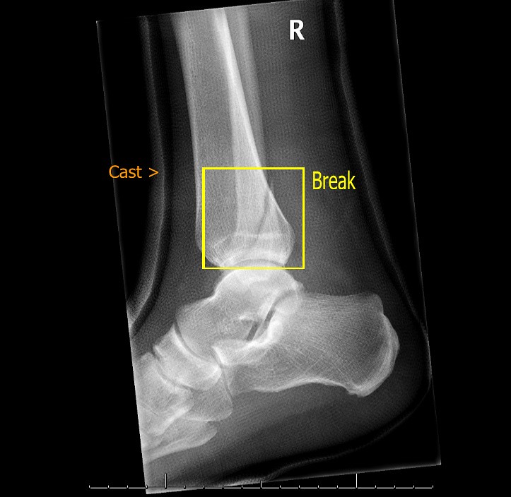 sprained ankle x ray