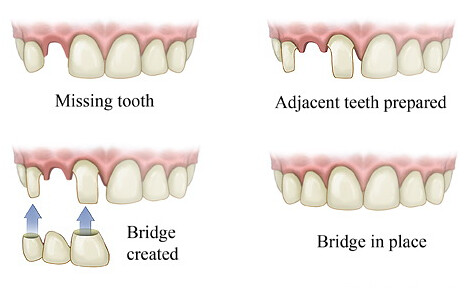 Best Dental Implants in India – Dental Implant India