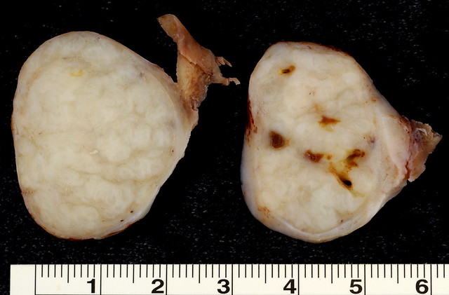 Adenomyoma of Ovary (gross)