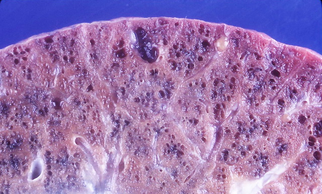 Honeycomb lung