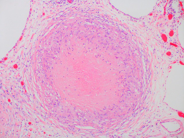 Pneumocystis jiroveci - granulomatous  Case 157