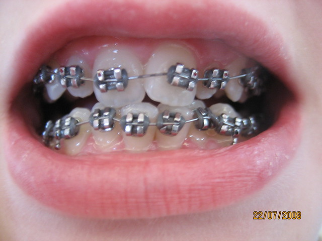 Anna's braces July 2009 at start of treatment