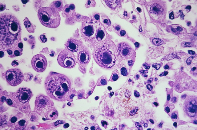 Cytomegalovirus infection - Case 301