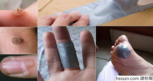 wart treatment duct tape)