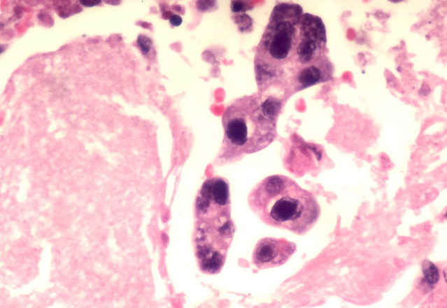 Cytomegalovirus and Pneumocystis coinfection - Case 302