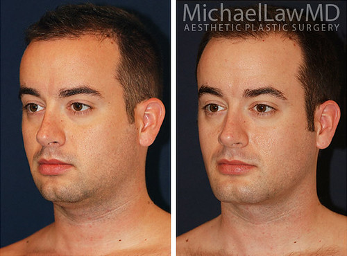 facial-implant-2o | by MichaelLawMD