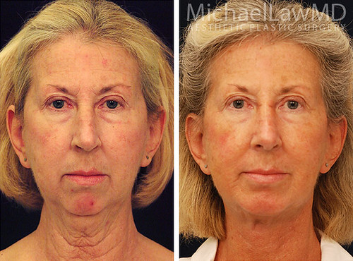facial-implant-6f | by MichaelLawMD