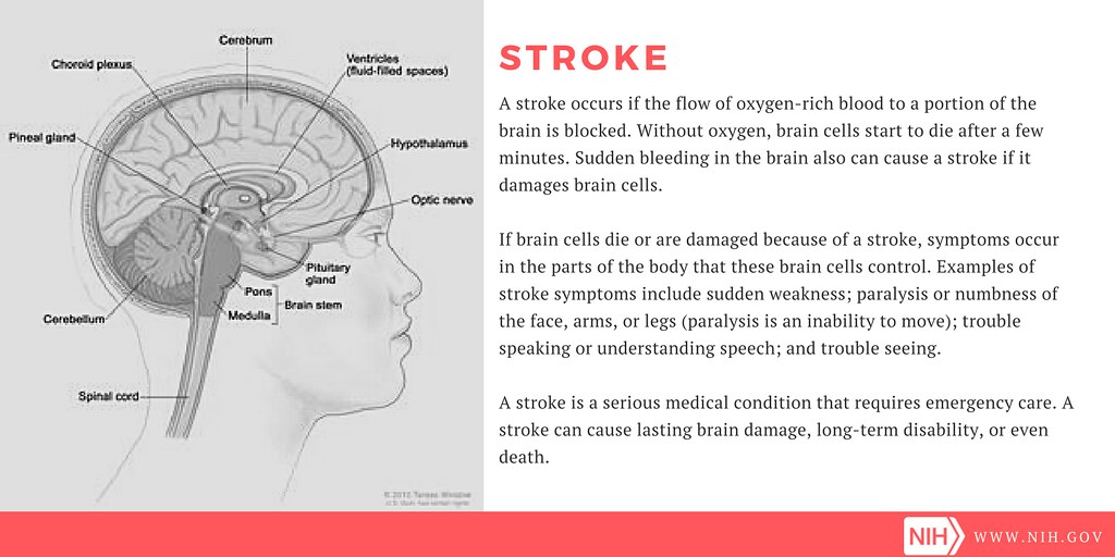 Stroke Definition And Symptoms A Graphic Depicting The Parts Flickr