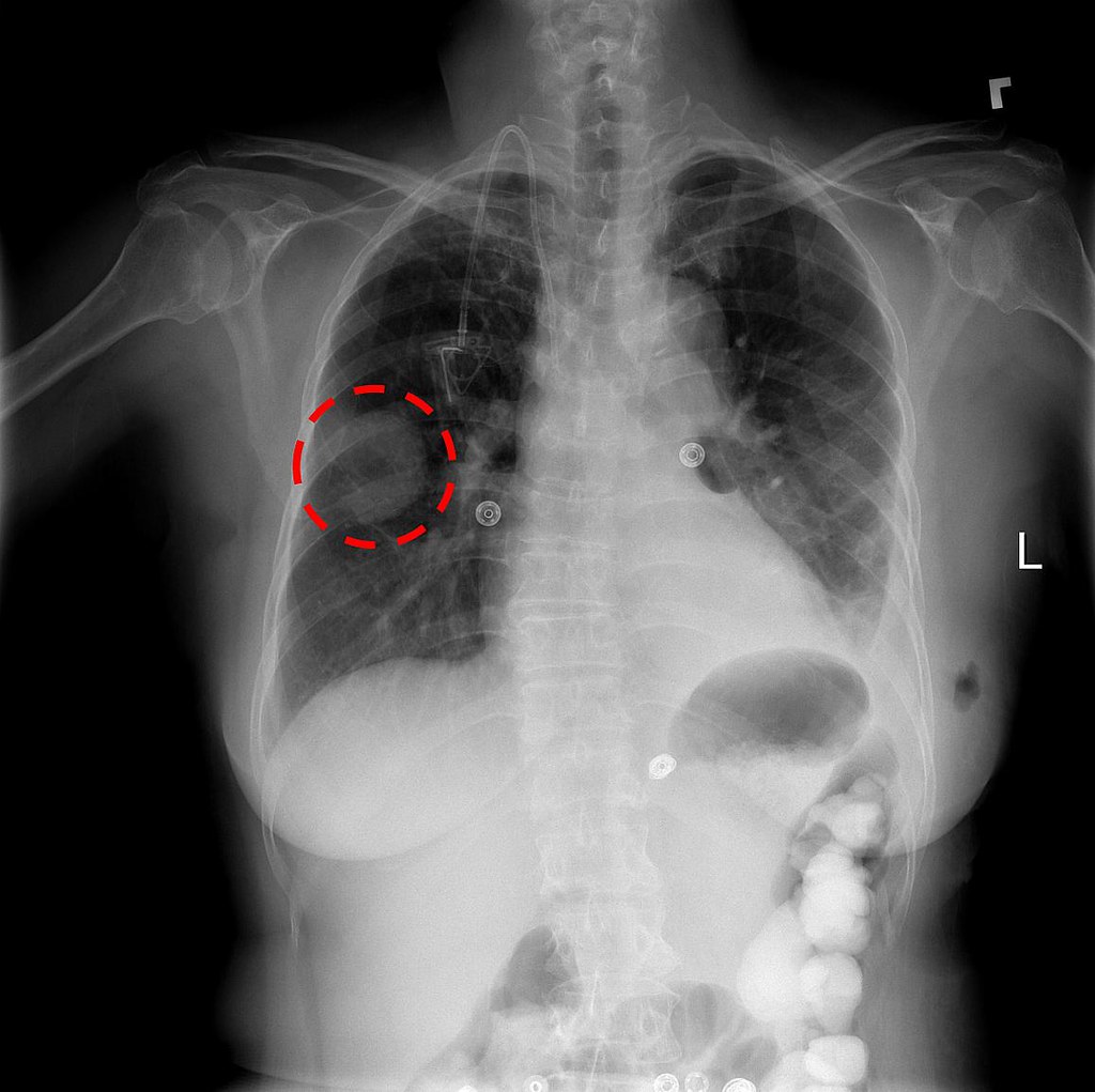 Normal Lung X Ray : healthy: Healthy Lungs Xray : Video includes the following image (among others):