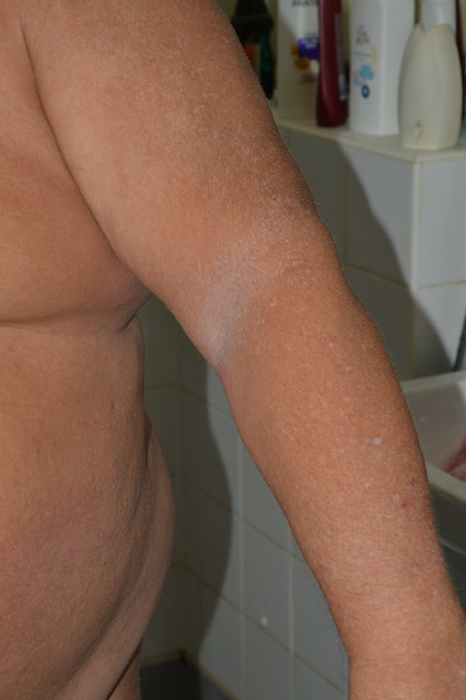 Left arm click on Z to see same rash on left side of my Belly and left arm from above elbow to hand