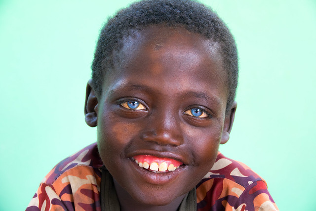Ethiopian boy called Abushe with blue eyes suffering from Waardenburg syndrome, Jinka, Omo valley , Ethiopia